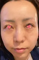 クマ治療 / 再生医療 / PRP皮膚再生療法 銀座よしえクリニック 銀座院 DAY 39 サムネイル用