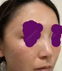 ヒアルロン酸注入（鼻） 新宿ビューティークリニック 新宿院 DAY 0 サムネイル用