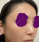 ヒアルロン酸注入（鼻） 新宿ビューティークリニック 新宿院 DAY 0 サムネイル用