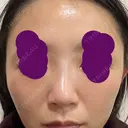 ヒアルロン酸注入（鼻） 新宿ビューティークリニック 新宿院 DAY 3 サムネイル用