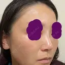 ヒアルロン酸注入（鼻） 新宿ビューティークリニック 新宿院 DAY 3 サムネイル用