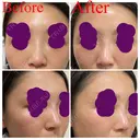 ヒアルロン酸注入（鼻） 新宿ビューティークリニック 新宿院 DAY 3 サムネイル用