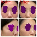 ヒアルロン酸注入（鼻） 新宿ビューティークリニック 新宿院 AFTER サムネイル用