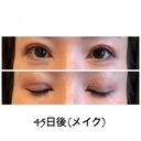 二重切開 / 目元修正 ビスポーククリニック 福岡院 DAY 45 サムネイル用
