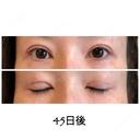 二重切開 / 目元修正 ビスポーククリニック 福岡院 DAY 45 サムネイル用