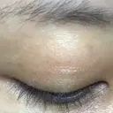 ほくろ・いぼ除去レーザー（肌） 仁愛クリニック DAY 28 サムネイル用