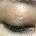 ほくろ・いぼ除去レーザー（肌） 仁愛クリニック DAY 28 サムネイル用