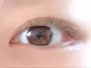 目頭切開 / 目尻切開 FROM B整形外科 (旧バウム整形外科) DAY 48 サムネイル用