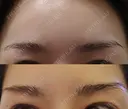 眉下切開 エイペックス美容外科 DAY 33 サムネイル用