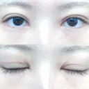 二重切開 松下皮フ形成外科 DAY 37 サムネイル用