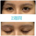 上まぶたの脂肪取り / 眉下切開 JUN CLINIC DAY 14 サムネイル用
