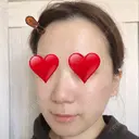 骨切り（あご） / 骨削り（エラ） リラ・クラニオフェイシャル・クリニック DAY 92 サムネイル用