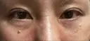下まぶたたるみ取り / 下まぶたの脂肪取り ヨーダー公子クリニック眼科・美容皮膚科 横浜六浦院 DAY 13 サムネイル用