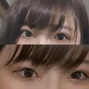 二重埋没 / 目頭切開 湘南美容クリニック 京都院 AFTER サムネイル用