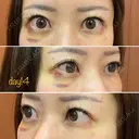 糸リフト / クマ治療 / 額を丸く / その他（輪郭） / こめかみ形成 / 脂肪注入（額） / 脂肪注入（輪郭） / その他（口元） 湘南美容クリニック 品川院 DAY 14 サムネイル用