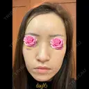 糸リフト / クマ治療 / 額を丸く / その他（輪郭） / こめかみ形成 / 脂肪注入（額） / 脂肪注入（輪郭） / その他（口元） 湘南美容クリニック 品川院 DAY 16 サムネイル用
