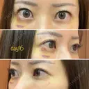 糸リフト / クマ治療 / 額を丸く / その他（輪郭） / こめかみ形成 / 脂肪注入（額） / 脂肪注入（輪郭） / その他（口元） 湘南美容クリニック 品川院 DAY 16 サムネイル用