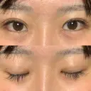 蒙古ひだ形成 R.O.clinic DAY 13 サムネイル用