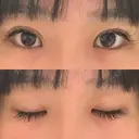 蒙古ひだ形成 R.O.clinic DAY 13 サムネイル用