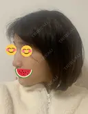 糸リフト / バッカルファット除去 / 脂肪吸引（顔） / ボトックス（エラ・小顔） WOM CLINIC GINZA （ワム クリニック ギンザ） DAY 29 サムネイル用
