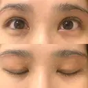 上まぶたの脂肪取り / 眉下切開 WOM CLINIC GINZA （ワム クリニック ギンザ） DAY 29 サムネイル用