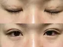 二重埋没 城本クリニック 静岡院 DAY 9 サムネイル用