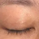 ほくろ・いぼ除去レーザー（肌） 仁愛クリニック DAY 34 サムネイル用