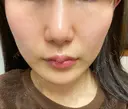 フォトRF 湘南美容クリニック 柏院 DAY 0 サムネイル用