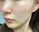 フォトRF 湘南美容クリニック 柏院 DAY 0 サムネイル用