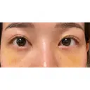 クマ治療 / 下まぶたの脂肪取り ルラ美容クリニック 高田馬場院 DAY 5 サムネイル用