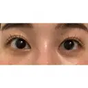 クマ治療 / 下まぶたの脂肪取り ルラ美容クリニック 高田馬場院 AFTER サムネイル用