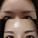 眉下切開 エイペックス美容外科 DAY 41 サムネイル用