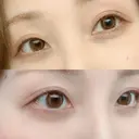 下まぶたたるみ取り 湘南美容クリニック 千葉センシティ院 AFTER サムネイル用