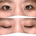 二重埋没 R.O.clinic DAY 80 サムネイル用