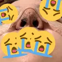 隆鼻術 / 鼻中隔延長（切開） / 小鼻縮小（切開） / 軟骨移植 樹のひかり 形成外科・皮ふ科 DAY 3 サムネイル用