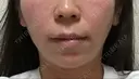 バッカルファット除去 / 脂肪吸引（顔） 湘南美容クリニック 那覇院 AFTER サムネイル用