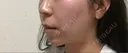 バッカルファット除去 / 脂肪吸引（顔） 湘南美容クリニック 那覇院 DAY 216 サムネイル用