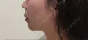 バッカルファット除去 / 脂肪吸引（顔） 湘南美容クリニック 那覇院 DAY 216 サムネイル用