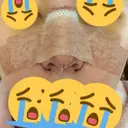 隆鼻術 / 鼻中隔延長（切開） / 小鼻縮小（切開） / 軟骨移植 樹のひかり 形成外科・皮ふ科 DAY 4 サムネイル用