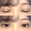 二重埋没 湘南美容クリニック 金沢院 DAY 2 サムネイル用