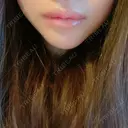 口唇縮小術 くさのたろうクリニック AFTER サムネイル用