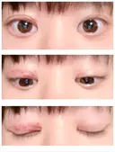 二重切開 / 眼瞼下垂（切開） 新前橋かしま眼科形成外科クリニック DAY 9 サムネイル用