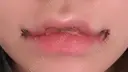口唇縮小術 / 口角挙上 B-LINE CLINIC 池袋院 DAY 5 サムネイル用