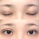 二重埋没 湘南美容クリニック 金沢院 DAY 3 サムネイル用