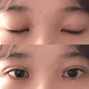 二重埋没 湘南美容クリニック 金沢院 DAY 4 サムネイル用