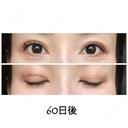 二重切開 / 目元修正 ビスポーククリニック 福岡院 DAY 60 サムネイル用