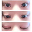 二重切開 / 眼瞼下垂（切開） 新前橋かしま眼科形成外科クリニック DAY 11 サムネイル用