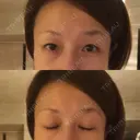 目尻切開 湘南美容クリニック 秋葉原院 DAY 65 サムネイル用