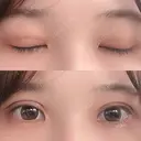 二重埋没 湘南美容クリニック 金沢院 DAY 6 サムネイル用