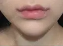 口唇縮小術 / 口角挙上 B-LINE CLINIC 池袋院 DAY 8 サムネイル用
